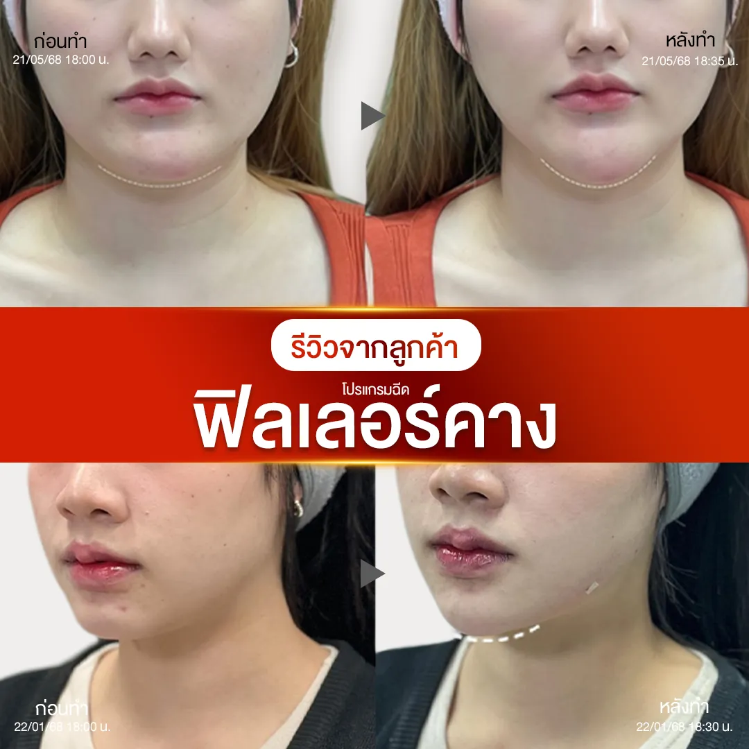 รีวิวฟิลเลอร์คางก่อนหลังทำ NV Clinic