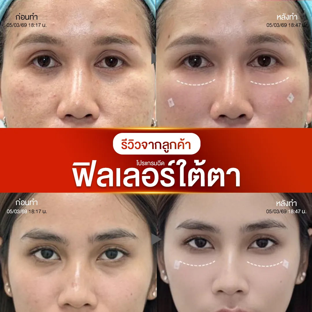 รีวิวฟิลเลอร์ใต้ตาก่อนหลังทำ NV Clinic