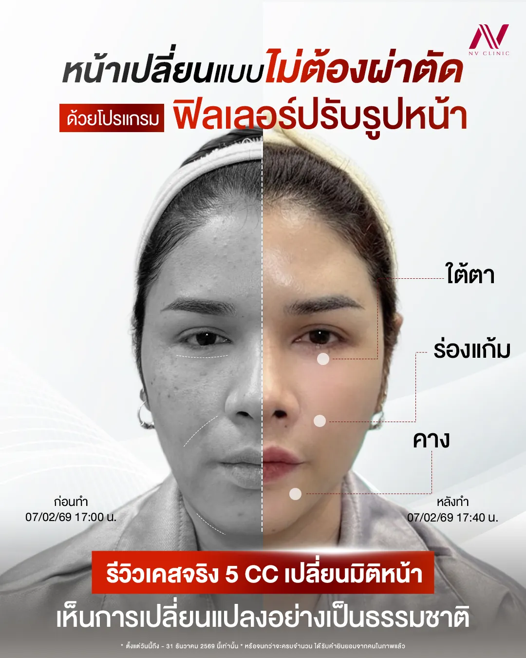 รีวิวฟิลเลอร์ปรับรูปหน้า 5 CC ก่อนหลัง NV Clinic