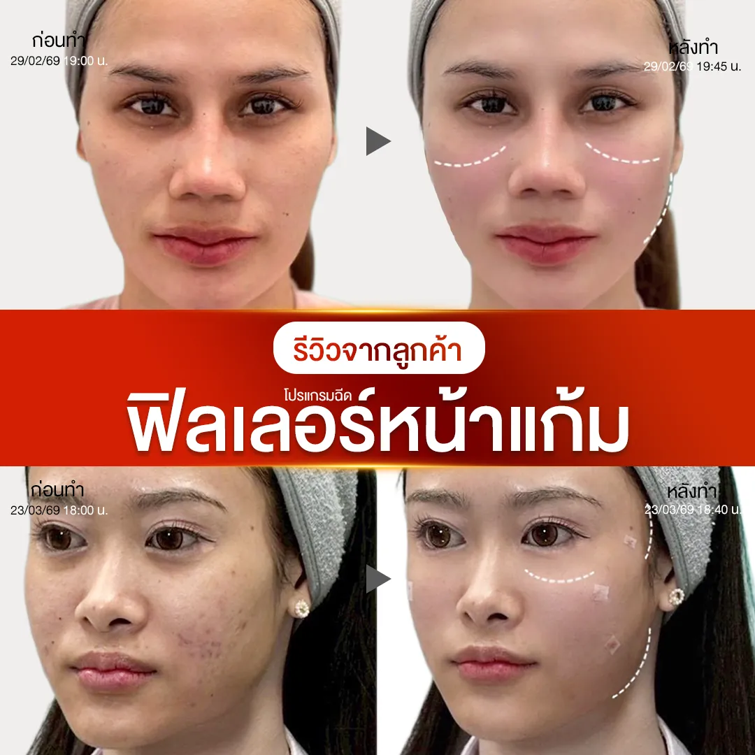 รีวิวฟิลเลอร์หน้าแก้มก่อนหลังทำ NV Clinic