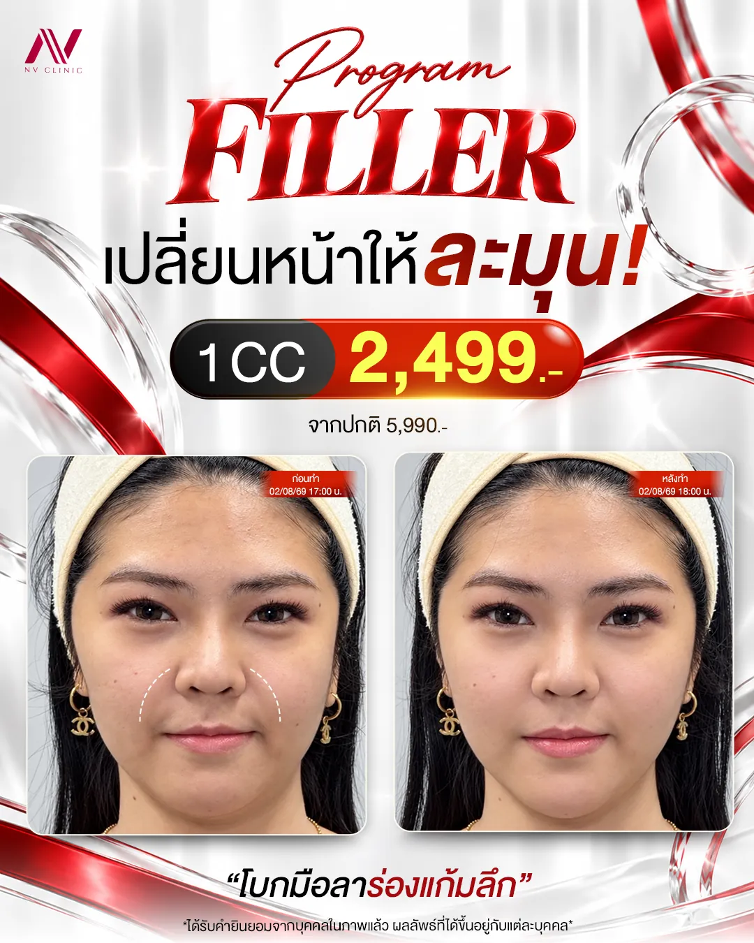 รีวิวฟิลเลอร์ร่องแก้มก่อนหลัง NV Clinic