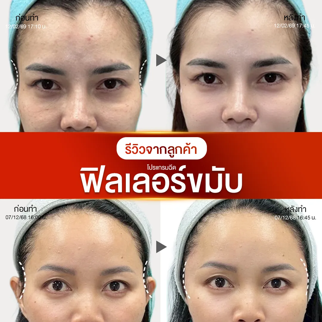 รีวิวฟิลเลอร์ขมับก่อนหลังทำ NV Clinic