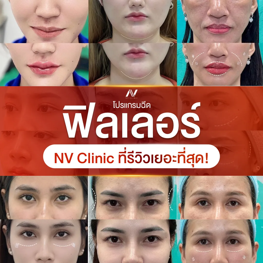 รวมรีวิวฟิลเลอร์ปาก ใต้ตา หน้าแก้ม NV Clinic