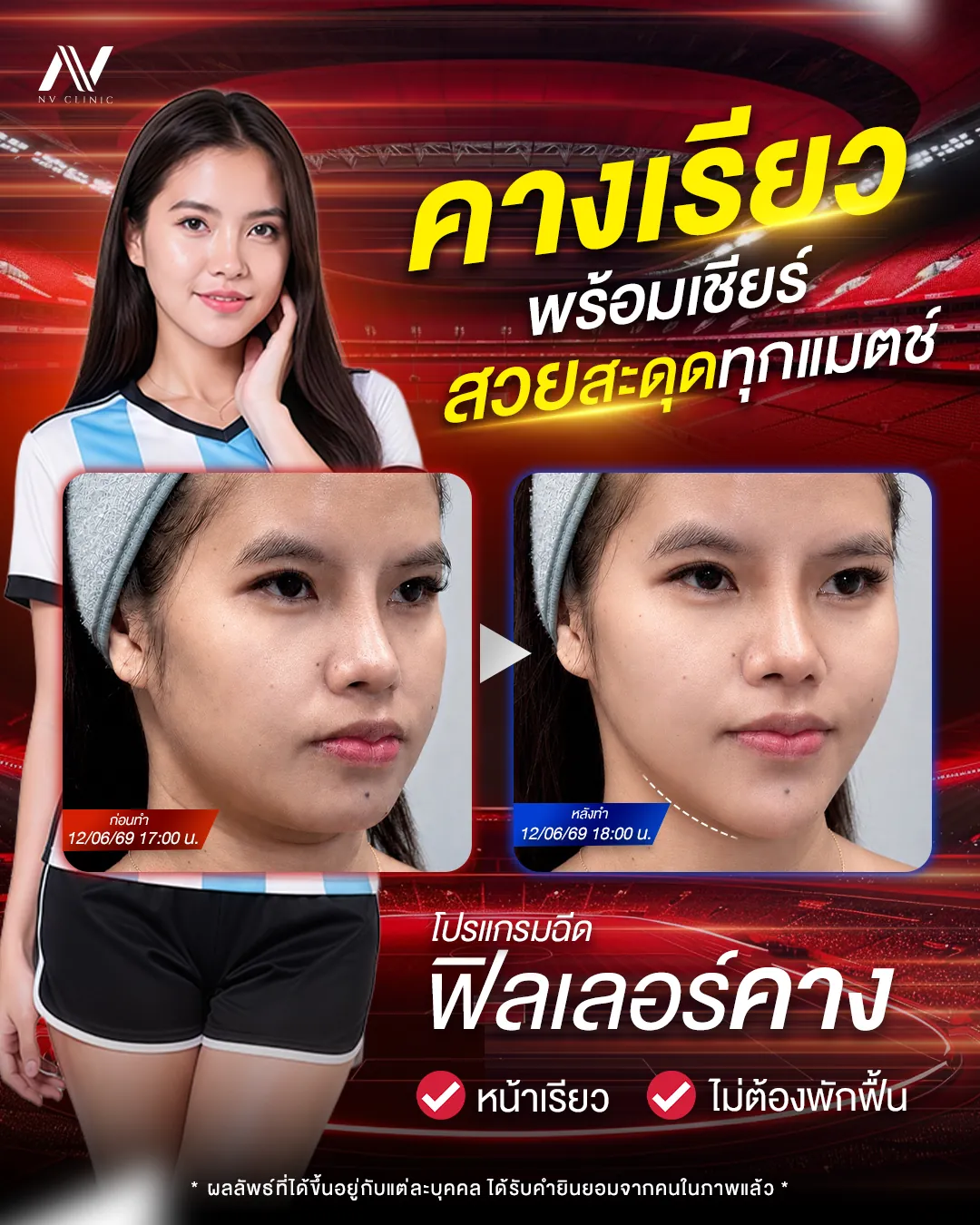 รีวิวก่อนหลัง ฟิลเลอร์คาง NV Clinic