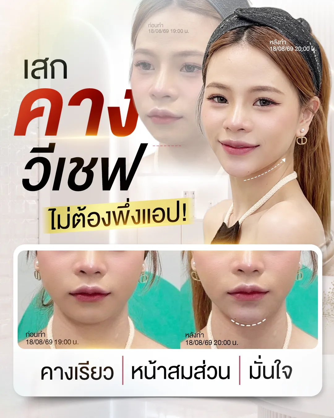 รีวิวก่อนหลัง ฟิลเลอร์คาง NV Clinic