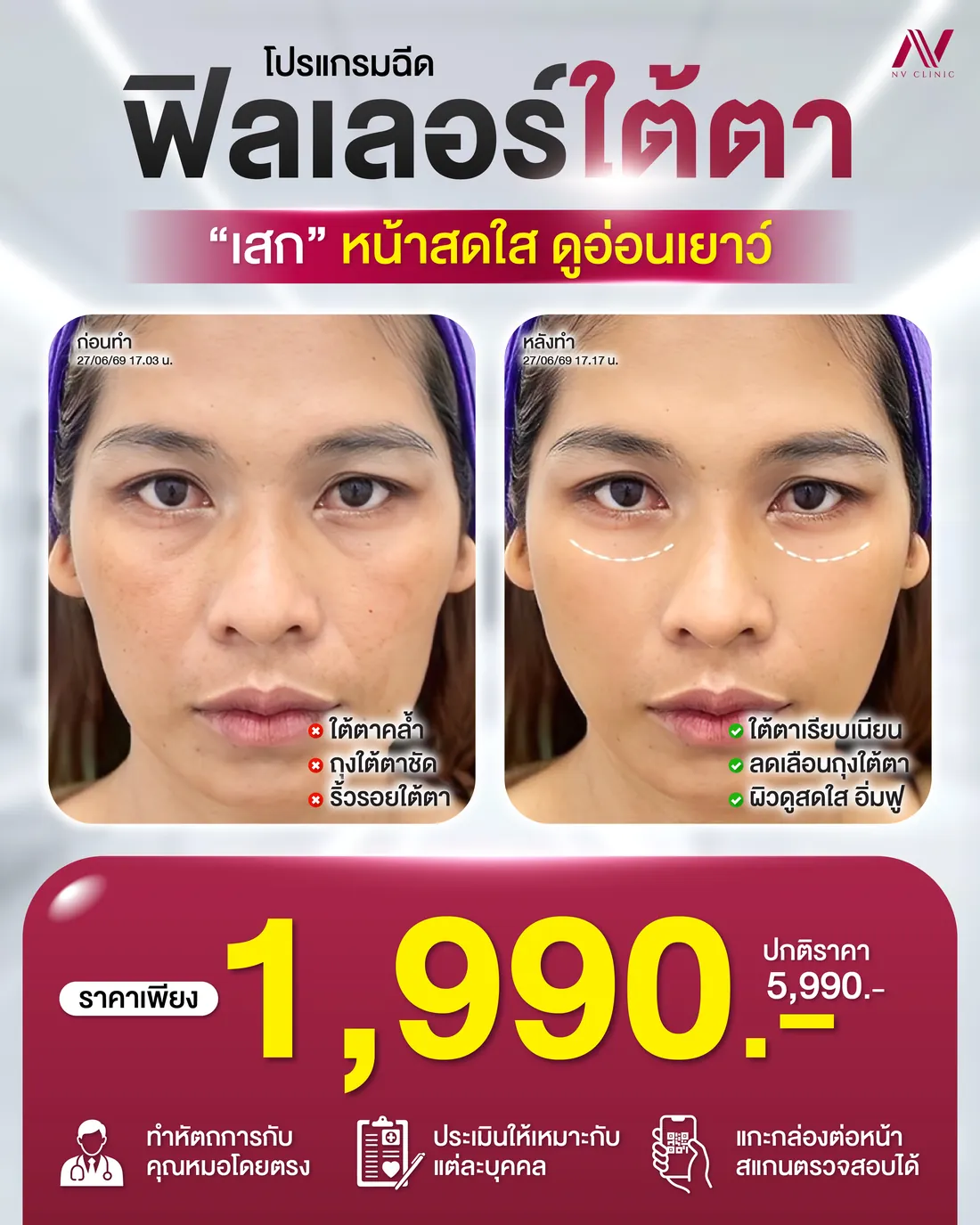 รีวิวก่อนหลัง ฟิลเลอร์ใต้ตา NV Clinic