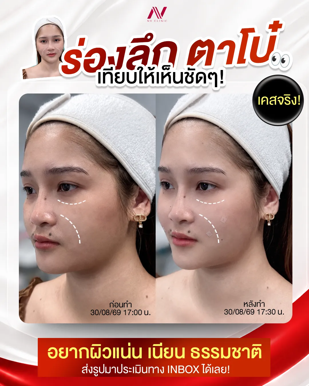 รีวิวก่อนหลัง ฟิลเลอร์หน้า/แก้ม/ขมับ NV Clinic