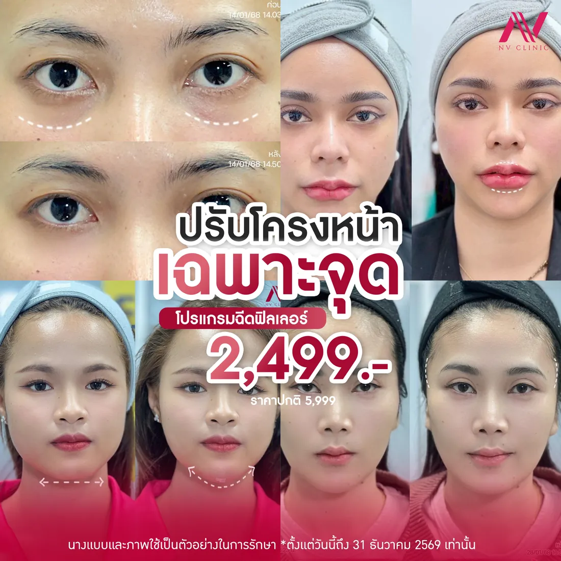 รีวิวก่อนหลัง ฟิลเลอร์หน้า/แก้ม/ขมับ NV Clinic