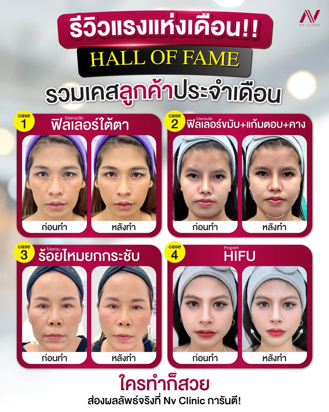 รีวิวก่อนหลัง ฟิลเลอร์หน้า/แก้ม/ขมับ NV Clinic