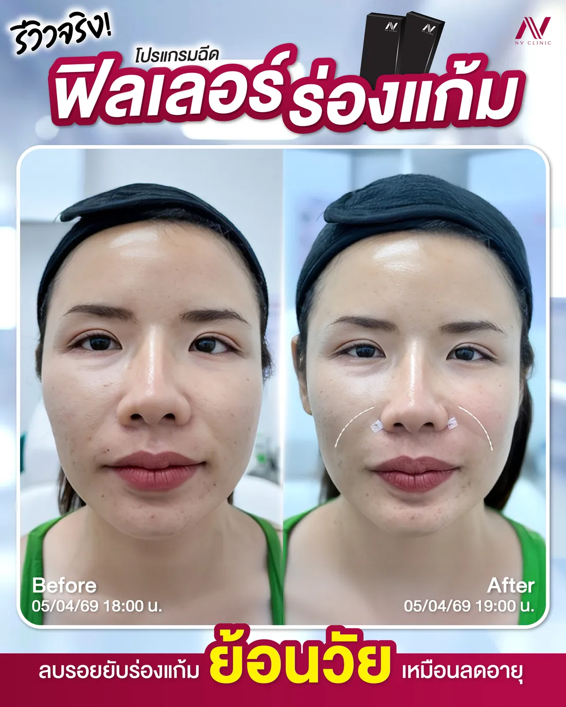 รีวิวก่อนหลัง ฟิลเลอร์หน้า/แก้ม/ขมับ NV Clinic