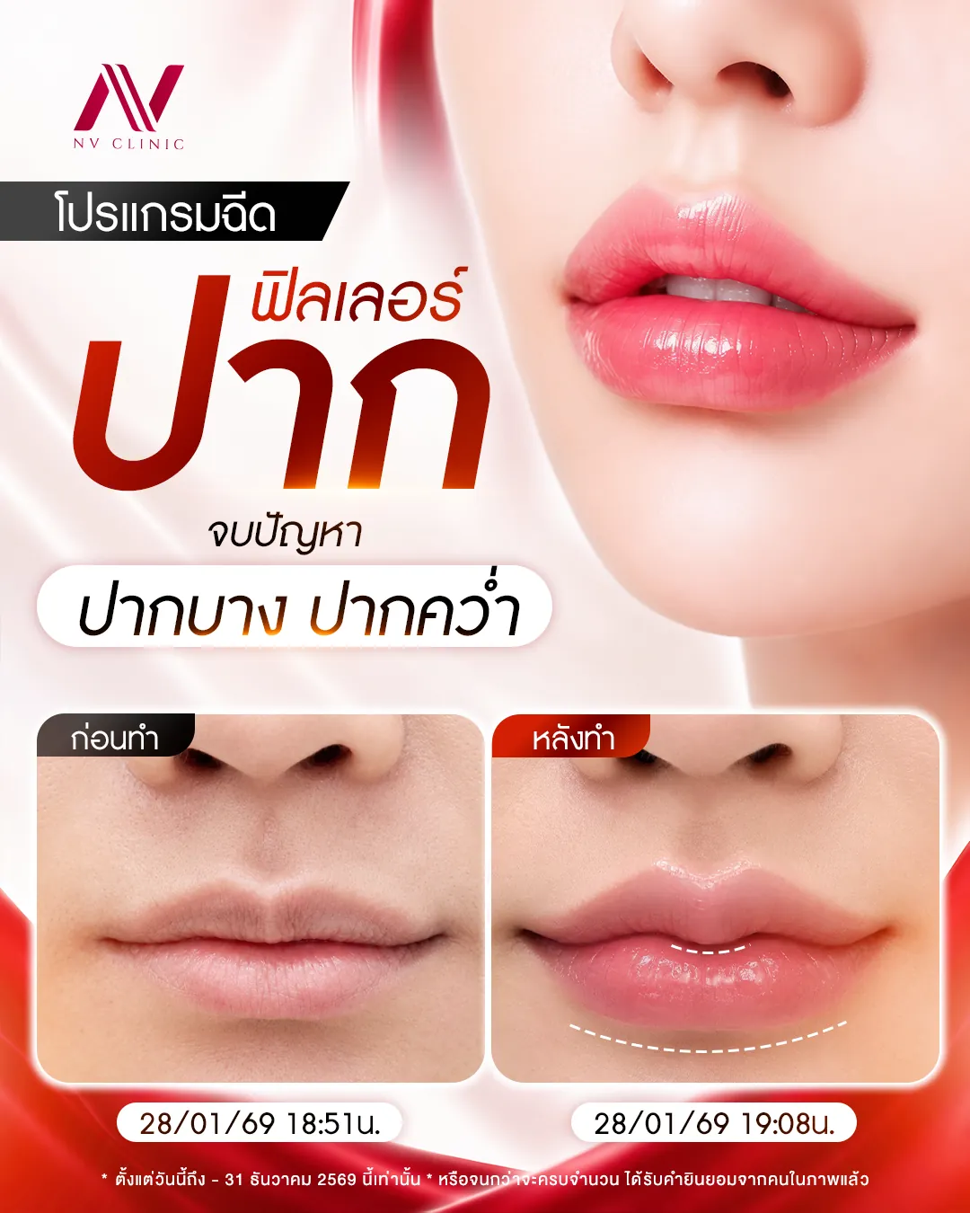 รีวิวก่อนหลัง ฟิลเลอร์ปาก NV Clinic