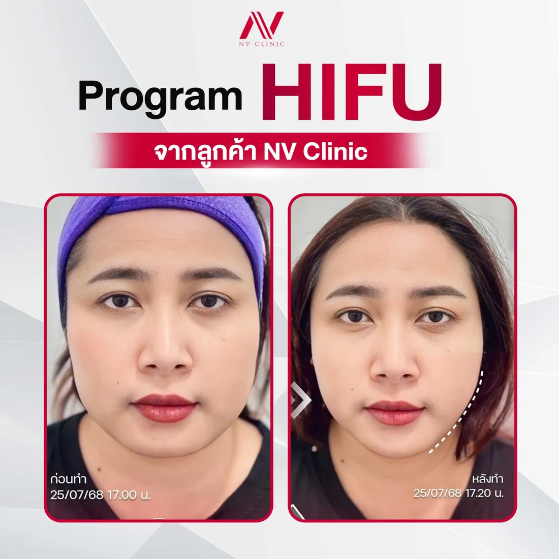 รีวิวก่อนหลังทำ HIFU ยกกระชับ NV Clinic