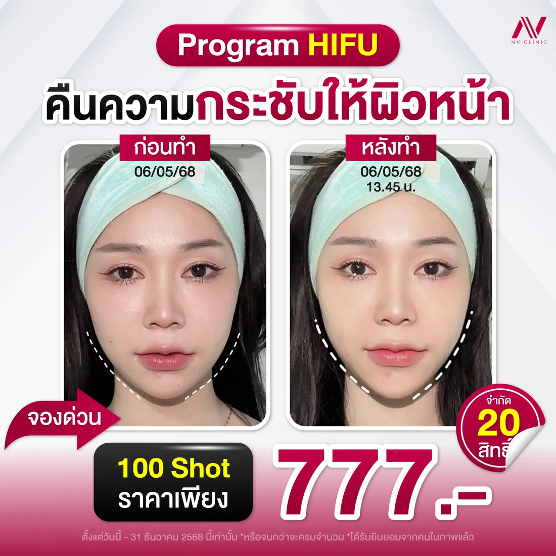 รีวิวก่อนหลัง HIFU ยกกระชับ NV Clinic