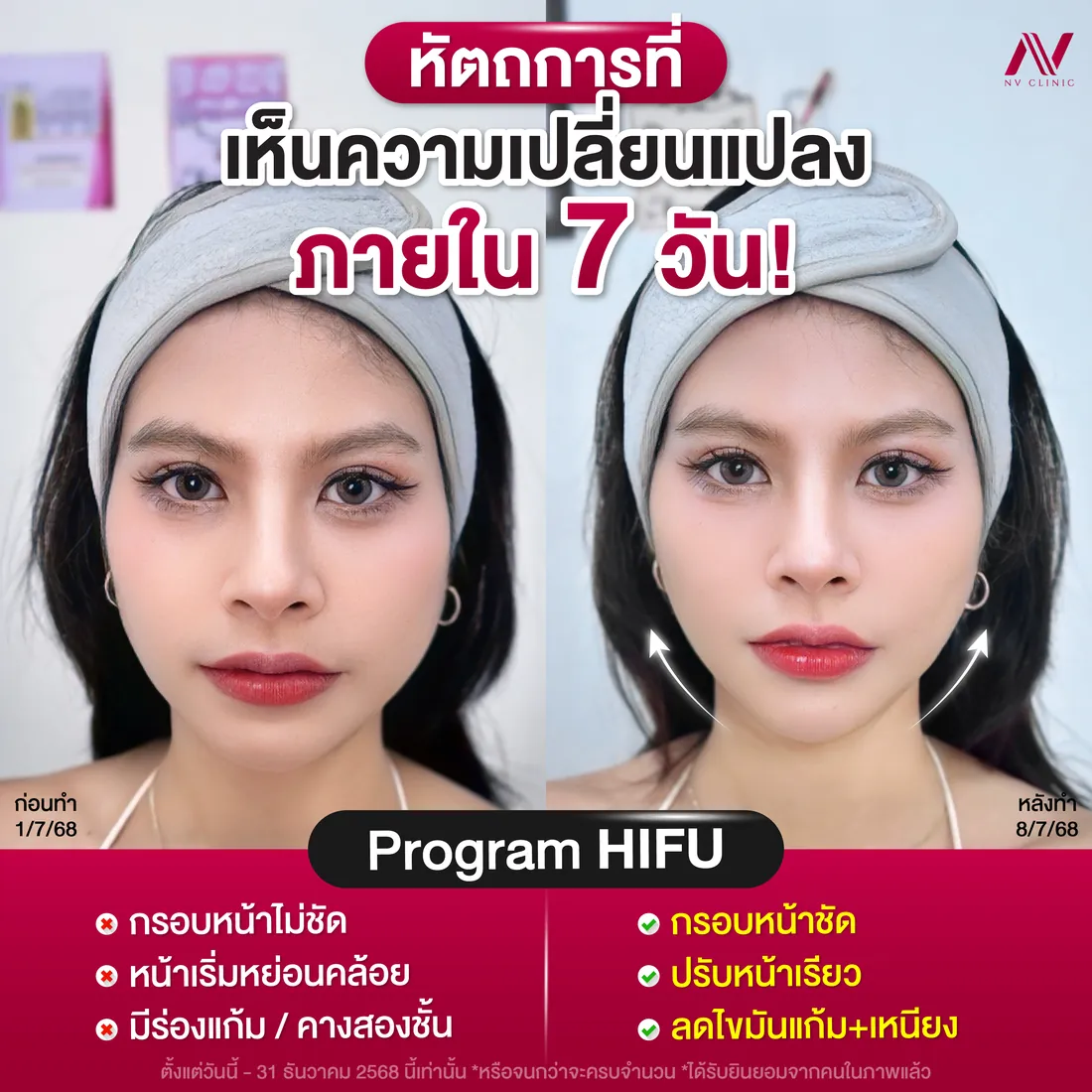 รีวิวก่อนหลัง HIFU ยกกระชับ NV Clinic