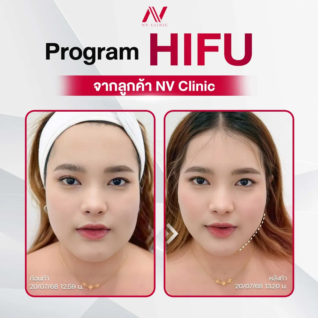 รีวิวก่อนหลัง HIFU ยกกระชับ NV Clinic