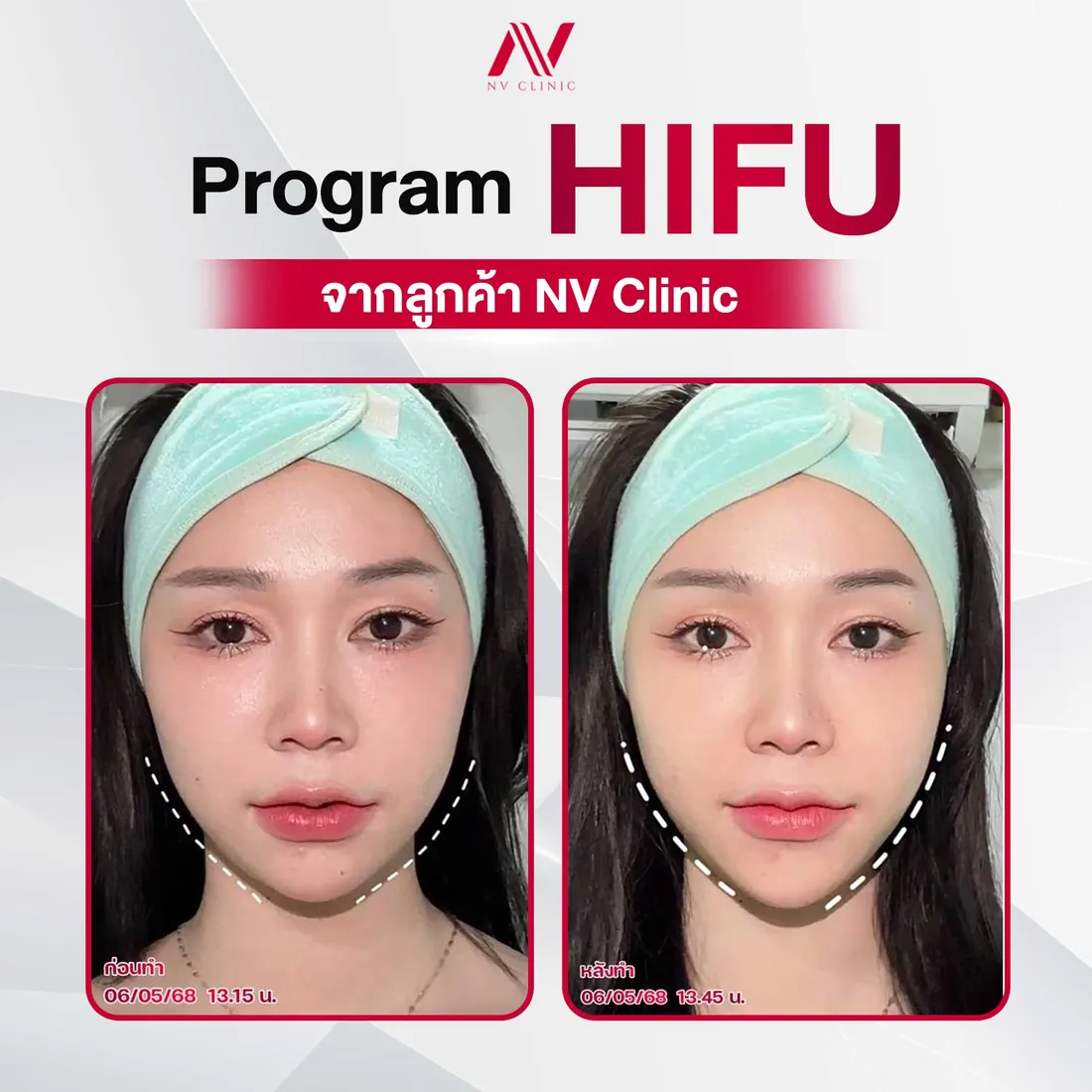 รีวิวก่อนหลัง HIFU ยกกระชับ NV Clinic