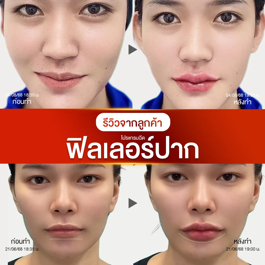 รีวิวก่อน-หลังฉีดฟิลเลอร์ปาก NV Clinic