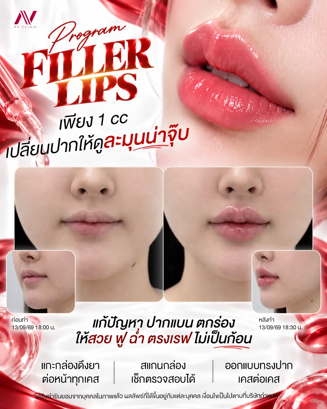 รีวิวฟิลเลอร์ปาก 1 CC ก่อนหลังทำ NV Clinic