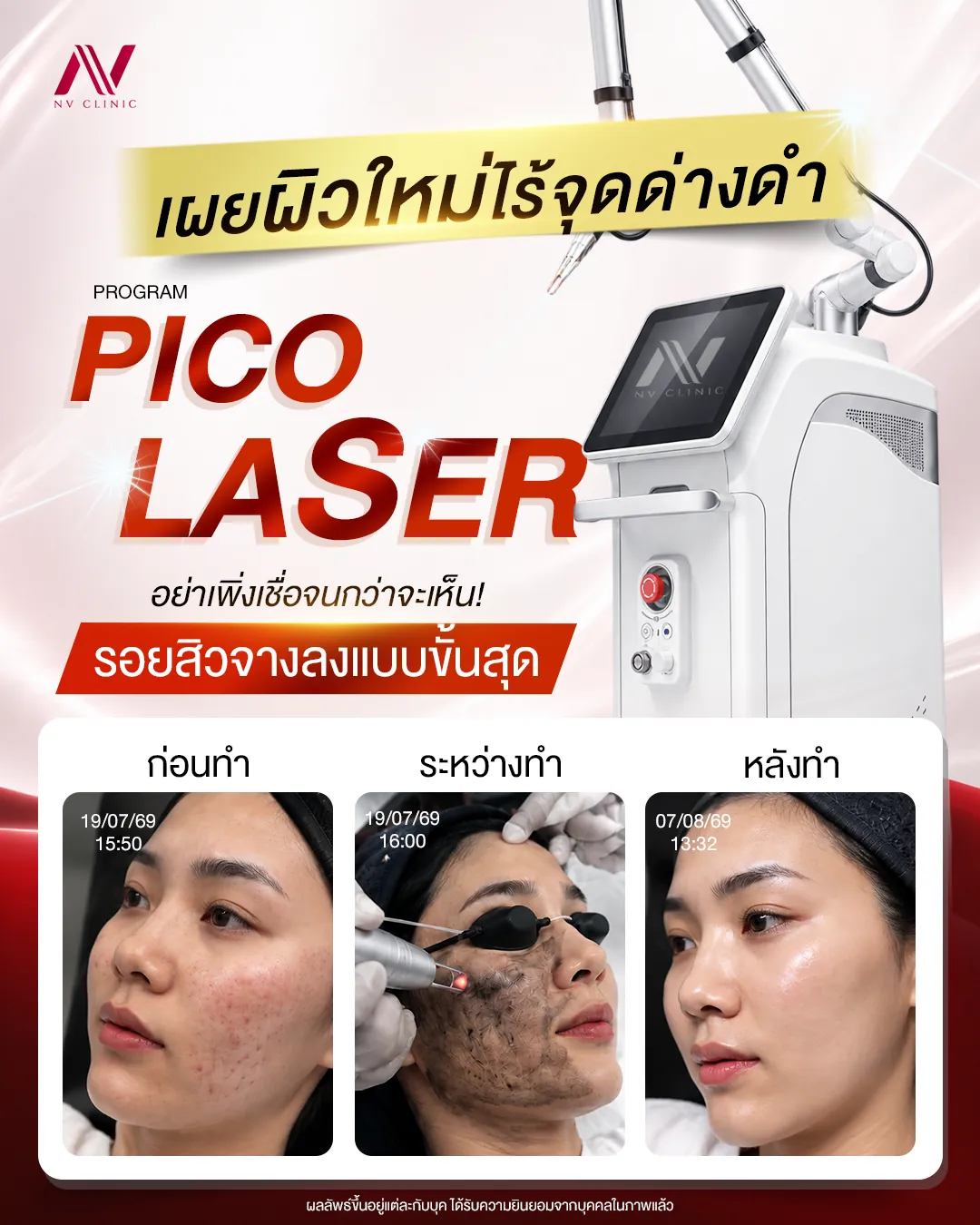 รีวิวก่อนหลัง Pico Laser NV Clinic