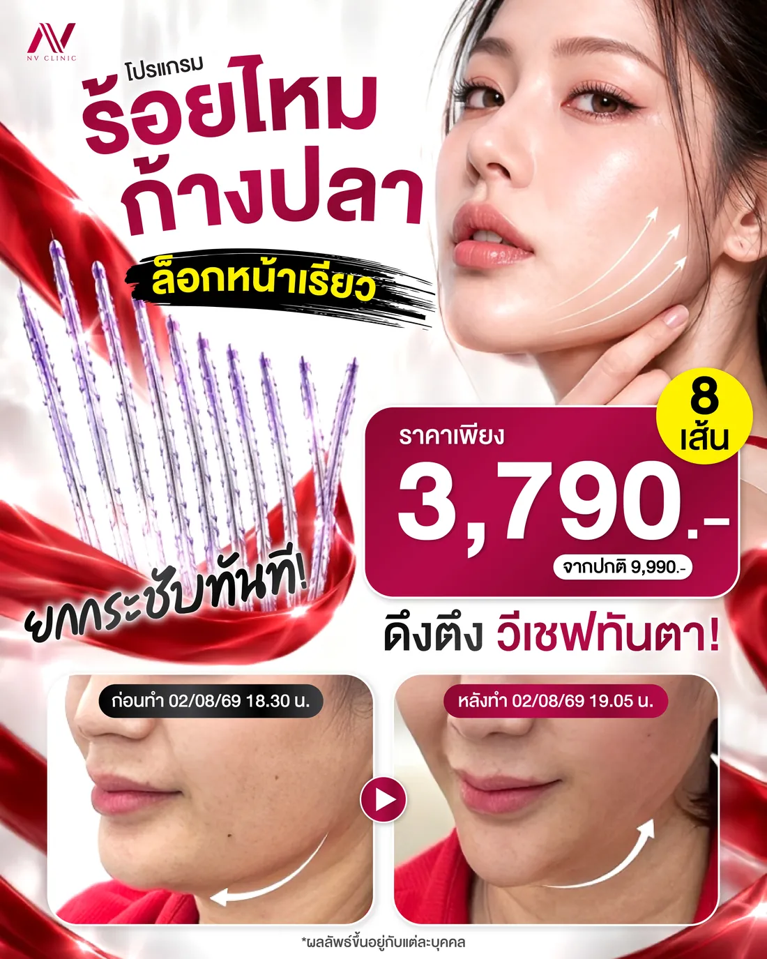รีวิวก่อนหลังร้อยไหมยกกระชับ NV Clinic