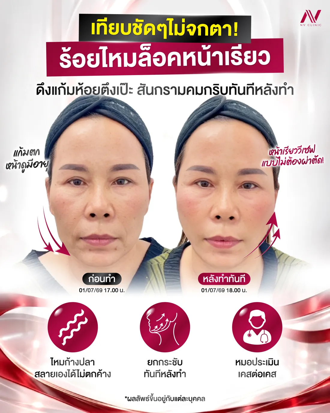 รีวิวก่อนหลัง ร้อยไหม NV Clinic